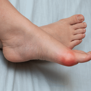 外反母趾が悪化して赤く腫れた足の写真。走れない時期の痛みを表すイメージ