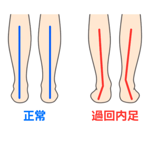 過回内足ストレッチの手順イラスト(足首のねじれ改善)
